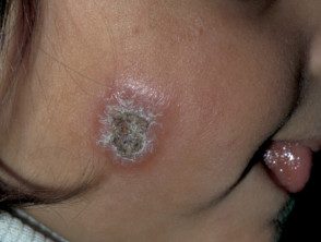 Tarija Reporta 26 Casos de Leishmaniasis en 2023: Autoridades Llaman a la Prevención