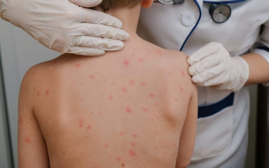 Cuatro nuevos casos sospechosos de sarampión alertan a Tarija autoridades sanitarias investigan brote potencial